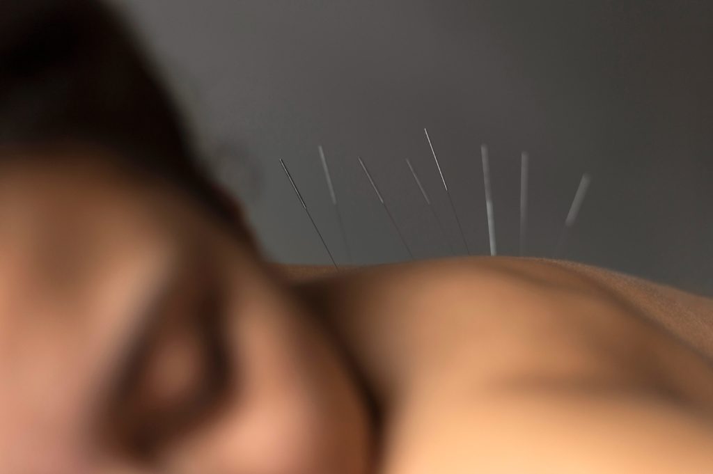 femme séance d'acupuncture détente et bien-être